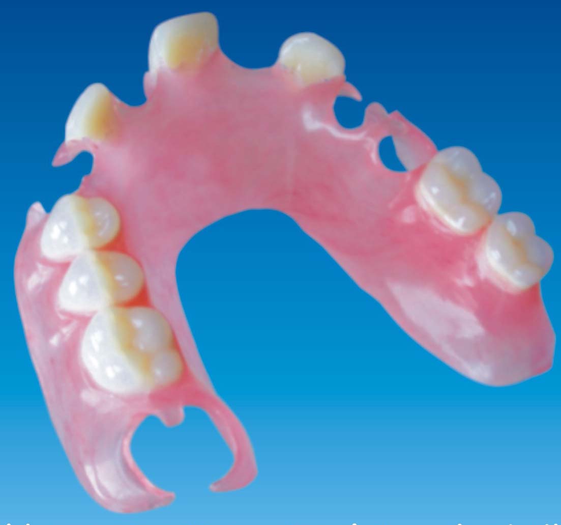 种植覆盖义齿（杆卡式） - 成都琢美义齿技术有限公司