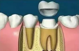 根管治疗会有副作用吗?